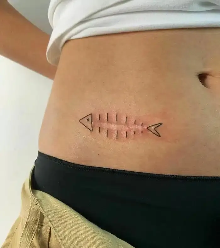 Tatouage recouvrant la cicatrice d'une femme formant un poisson